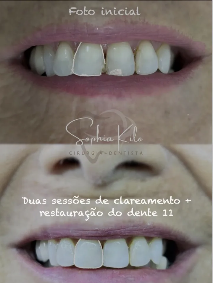 Antes e depois de clareamento dental com restauração do dente 11: dentes visivelmente mais claros e uniformes
