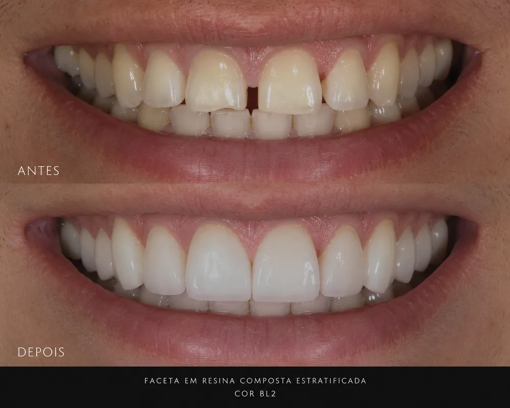 Antes e depois de faceta em resina composta estratificada: sorriso com espaços e desgastes transformado em sorriso uniforme e natural