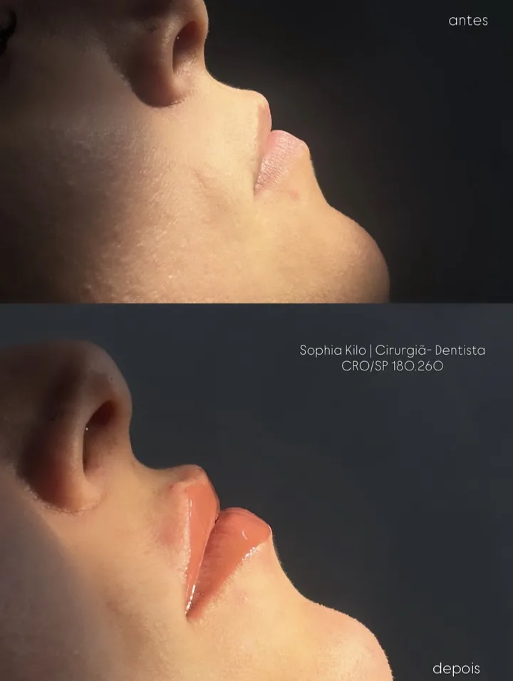 Antes e depois de harmonização orofacial: perfil dos lábios com contorno e projeção naturais