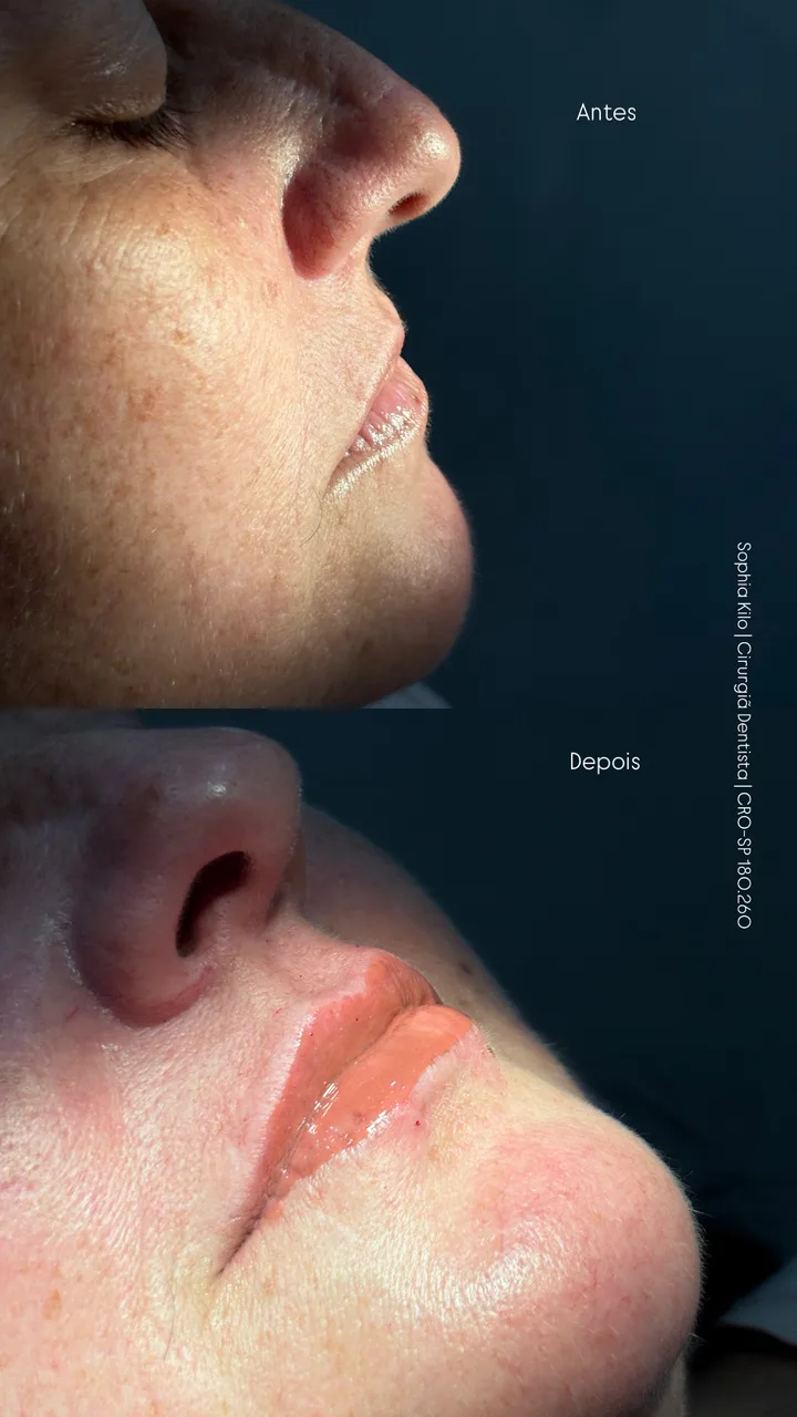 Antes e depois de harmonização orofacial em paciente madura: lábios com volume e definição preservando a naturalidade