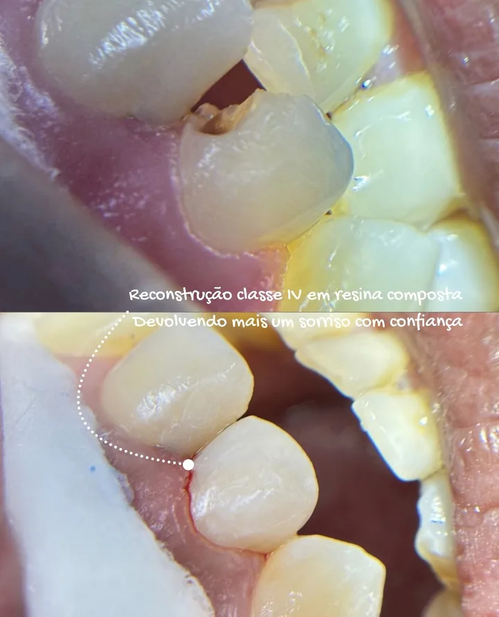 Antes e depois de reconstrução classe IV em resina composta: dente restaurado com anatomia natural