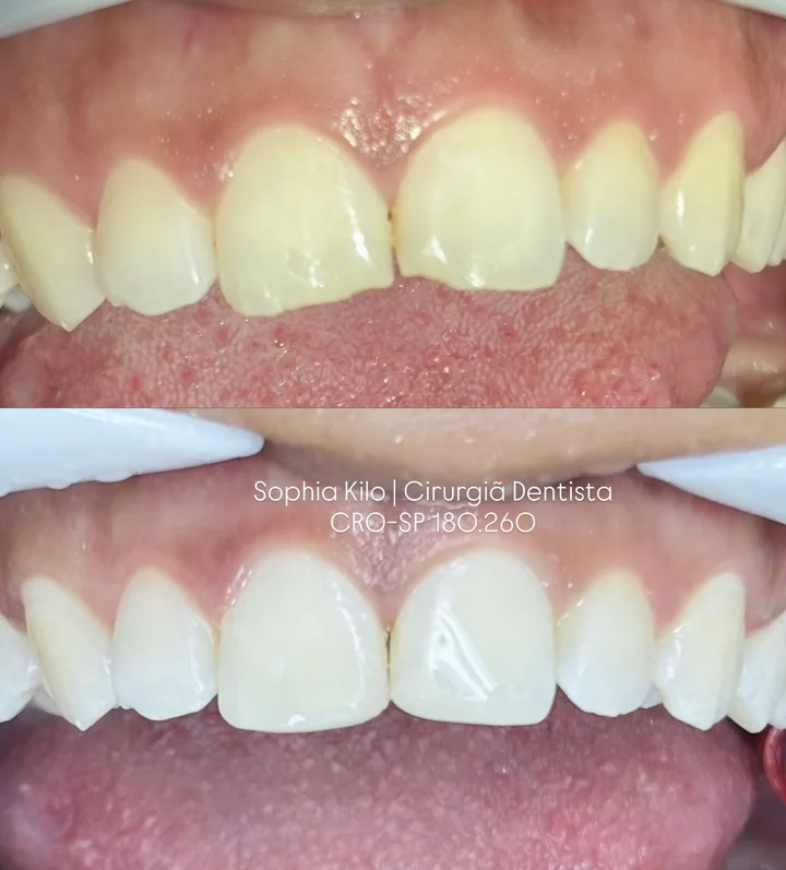 Antes e depois de restauração estética dos dentes da frente: bordas irregulares corrigidas com acabamento natural